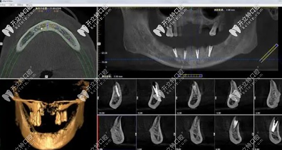 ALL-ON-4種植牙的3D動(dòng)畫演示圖