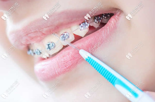 榆次區(qū)萊特口腔的牙齒矯正參考價(jià)格