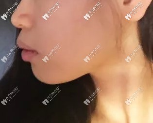 我上牙骨性前凸已經(jīng)戴了39幅隱適美隱形牙套,臉型變化很大