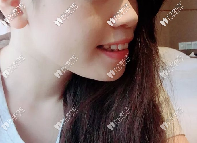 骨性嘴凸佩戴第39幅牙套側(cè)臉變化很大