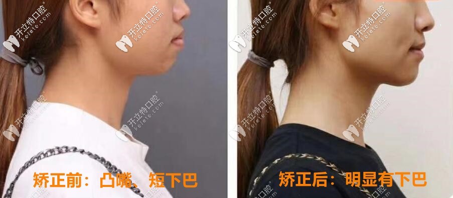 00后妹子骨性凸嘴:拔4顆牙做金屬托槽矯正2年后臉型變化賊大