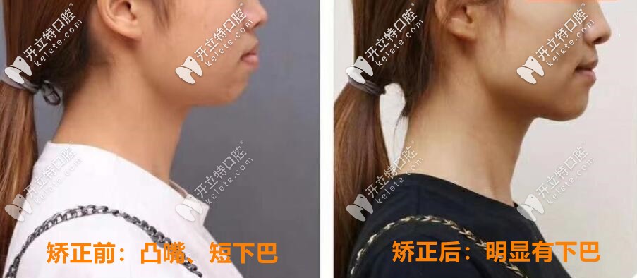 矯正前后對(duì)比照片：明顯有下巴，側(cè)顏好看