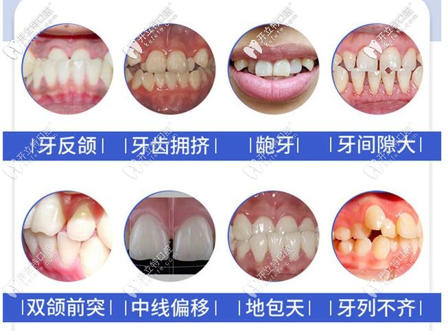 想知道重慶時代天使矯正價格嗎？世紀(jì)美奧口腔活動價19800