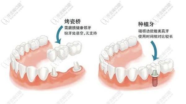 種植牙與烤瓷牙區(qū)別