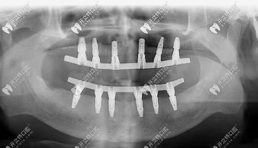 爺爺在北京平谷美銘做的allon6全口種植牙,上下各打了6個釘