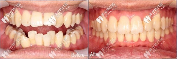 昆明尚愛韓美口腔做自鎖托槽矯正好嗎?看看環(huán)城南路的評(píng)價(jià)