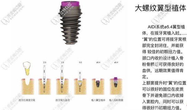 aidi屬大螺紋翼型植體