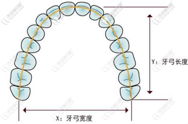 8-14歲的兒童使用牙齒擴弓的費用大概是多少？