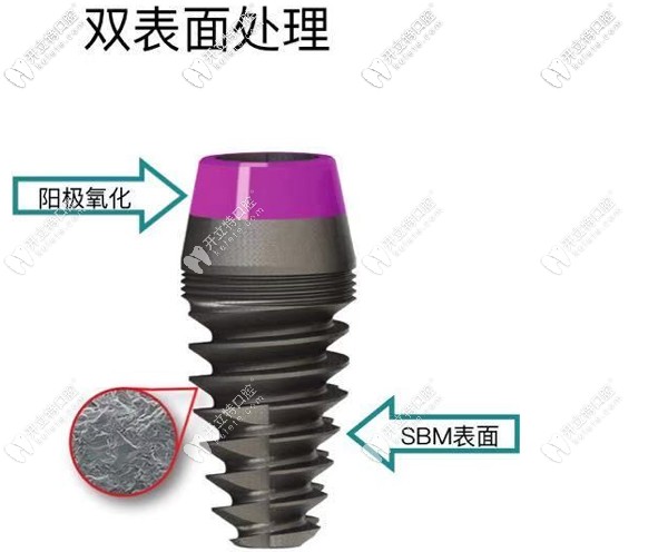 美國艾迪AIDI種植牙怎么樣，從aidi植體特點(diǎn)及價(jià)格來看