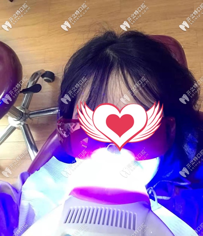 西安佳美口腔牙齒美白案例