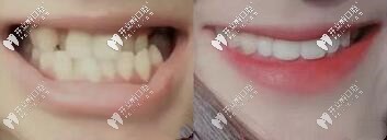 黃醫(yī)生：地包天、反頜復(fù)雜案例矯正