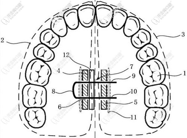 牙齒擴(kuò)弓器的特點