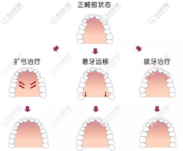 牙齒矯正使用擴(kuò)弓、磨牙遠(yuǎn)移、拔牙等都行