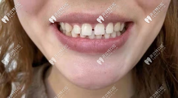 分享我門牙縫大做8顆美加全瓷牙貼面的案例感受，附效果圖