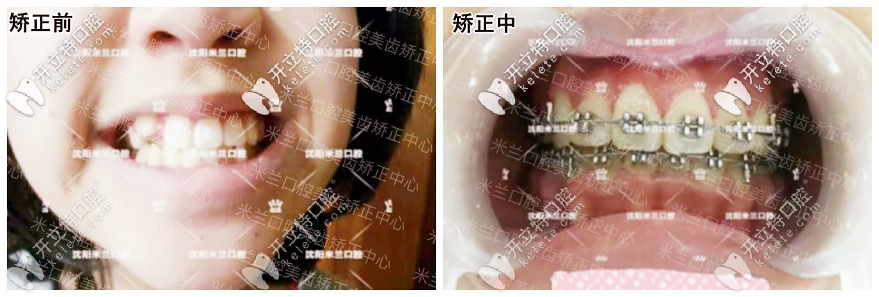 沈陽米蘭口腔矯正案例