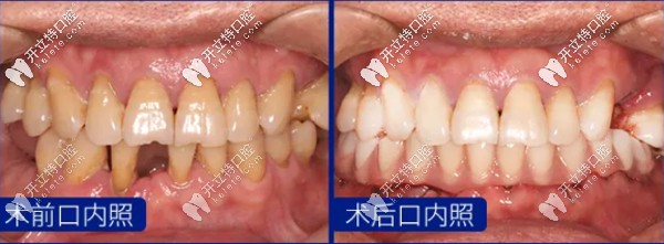 美奧王旭醫(yī)生做單顆牙種植