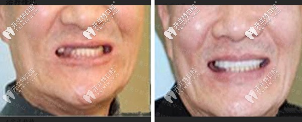 多顆牙缺失種植牙案例