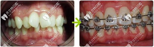 平江致遠口腔：孫醫(yī)生完成的金屬牙套<span style=