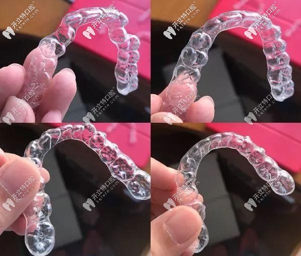 隱形牙套的外觀實拍圖