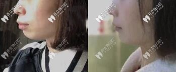 深覆合、齙牙顧客—拔牙7顆做的美國進口自鎖金屬托槽