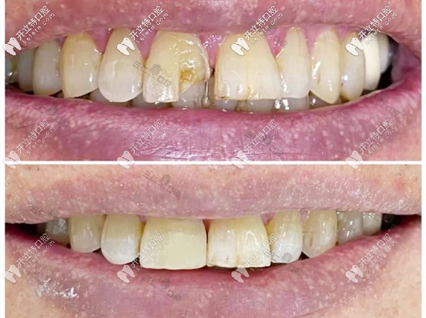 芭芭拉醫(yī)生的門牙修復案例圖