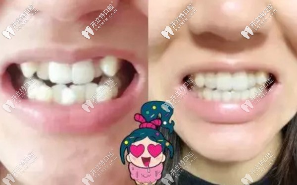 隱適美隱形矯正案例