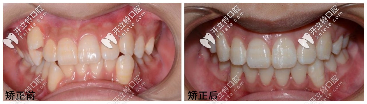 洛陽維樂口腔矯正案例