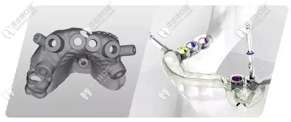 數(shù)字化導(dǎo)板種植的外觀