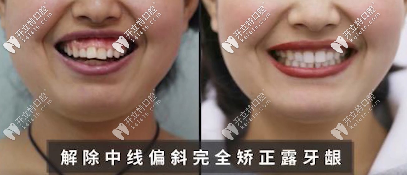 解決了露齦笑額齙牙的問(wèn)題，小姐姐笑的不要太開心