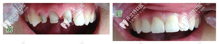 全瓷牙前后對(duì)比照片圖