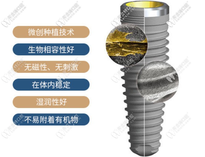 瑞典諾貝爾種植牙一顆多少錢(qián)