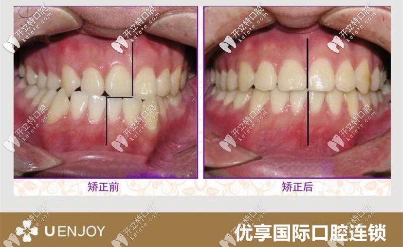 張醫(yī)生：獨特設(shè)計中線偏離矯正案例