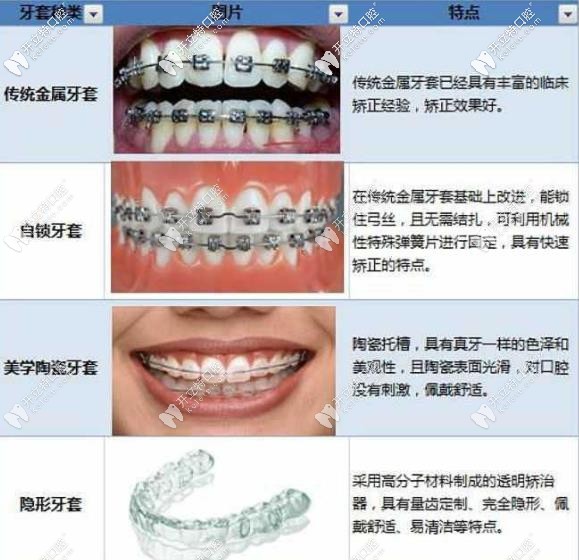 幾款常見牙套的優(yōu)劣勢(shì)對(duì)比