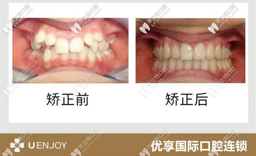 齙牙妹妹牙齒矯正前后變化圖