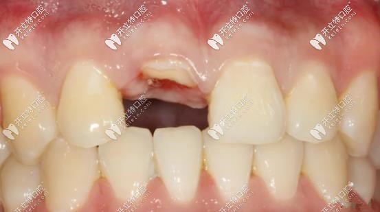 前牙區(qū)應(yīng)用盾構(gòu)術(shù)進(jìn)行即刻種植案例更新,美學(xué)效果更贊！