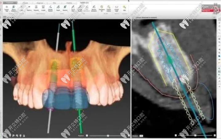 種植術(shù)前定位系統(tǒng)
