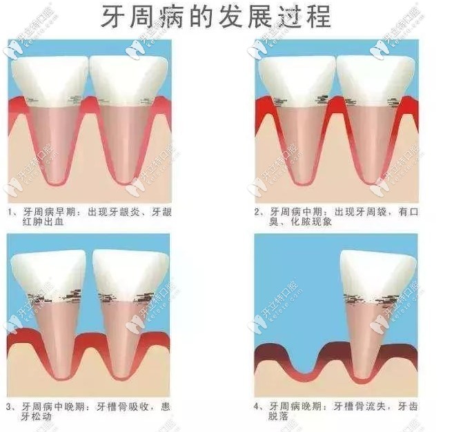 牙周病的發(fā)展過(guò)程