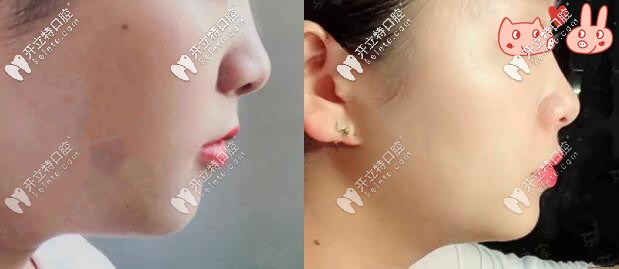 1年后側(cè)面對比圖，效果顯著