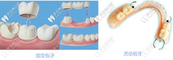 烤瓷牙和活動(dòng)義齒區(qū)別
