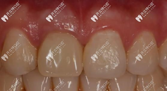 即刻種植術(shù)后帶上牙冠的樣子