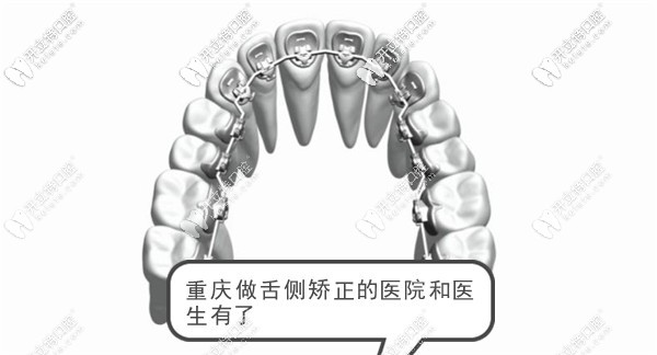 重慶的口腔醫(yī)院中有可以做ebrace舌側(cè)隱形矯正比較好的醫(yī)生