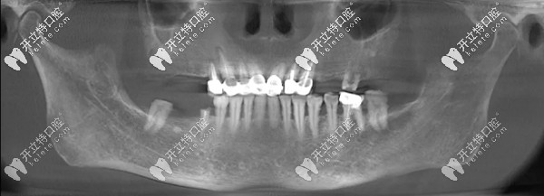 15分鐘種3顆牙的王阿姨感言：德國(guó)生長(zhǎng)因子種植牙技術(shù)真牛