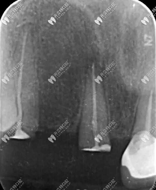 牙齒殘根需謹慎拔除,殘牙根上可鑲假牙防止牙槽骨萎縮哦