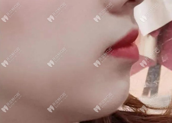 矯正齙牙后的側面效果圖