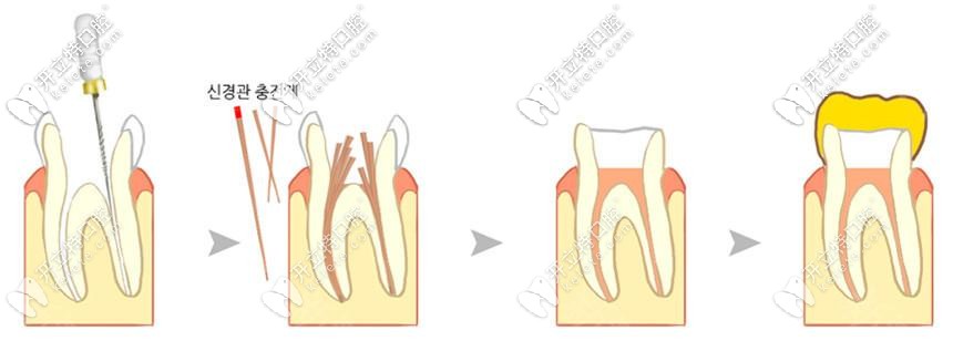 根管治療步驟過程及動(dòng)畫視頻圖解,看根管治療4次哪次比較痛