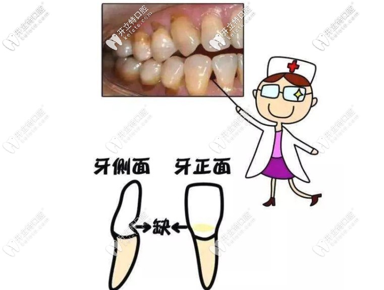 其實(shí)很多楔狀缺損都是刷牙導(dǎo)致的，早發(fā)現(xiàn)早治療哦~