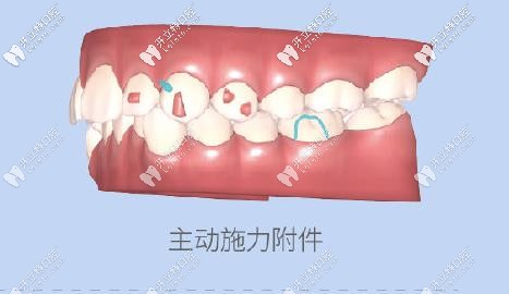 附件會對牙齒進行施力