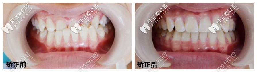 地包天矯正后的前后對比