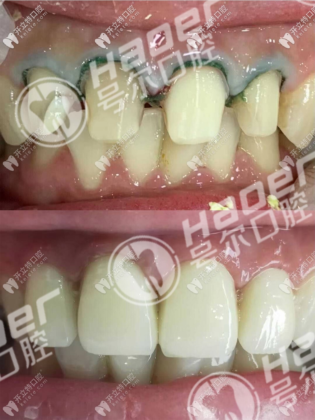 說不痛苦是假的,談?wù)勎铱敬裳烙?年后拆了換全瓷牙過程！