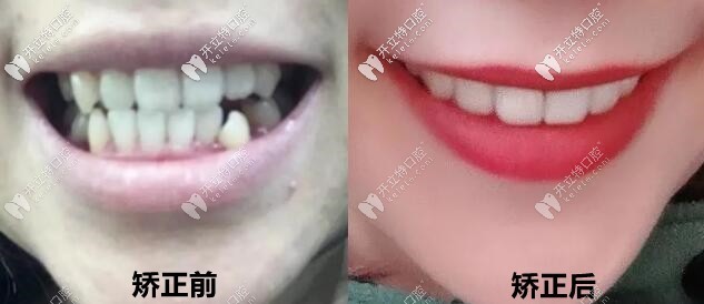 正畸案例:妹妹中線不齊+臉歪做的金屬自鎖矯正后圖片分享